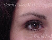 Blepharoplasty before and after - before