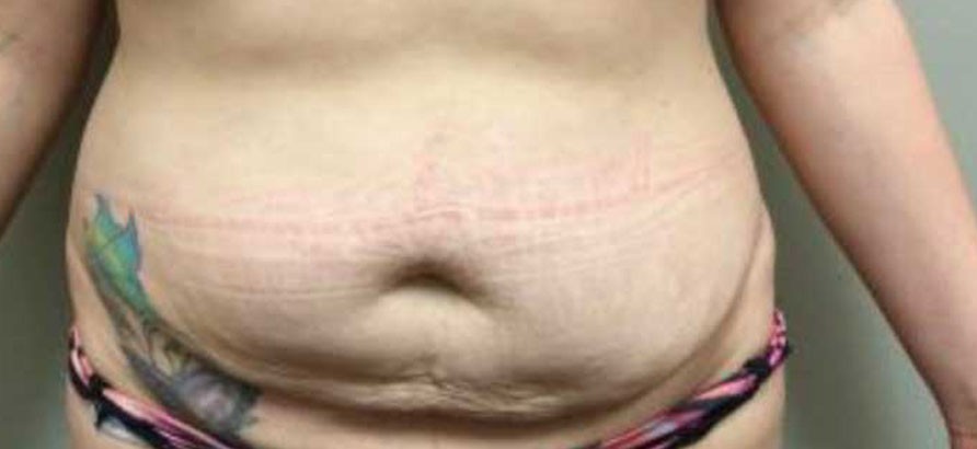 Abdominoplasty before and after - before