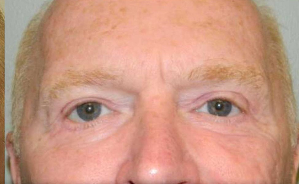 Eye Lift before and after - after