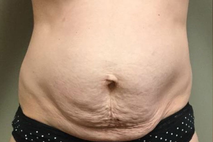 Abdominoplasty before and after - before