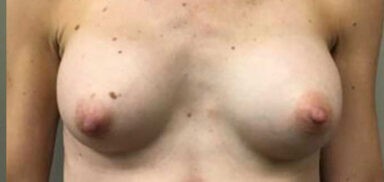 Breast Augmentation before and after - after
