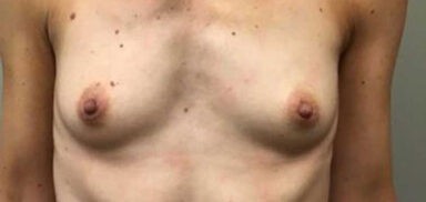 Breast Augmentation before and after - before
