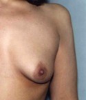 Breast Augmentation before and after - after