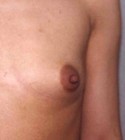 Breast Augmentation before and after - after