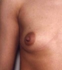 Breast Augmentation before and after - before