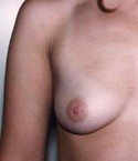 Breast Augmentation before and after - before