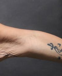 Arm Lift after — Dr. Joshua Korman