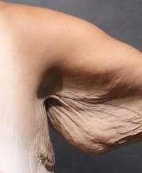 Arm Lift before — Dr. Joshua Korman