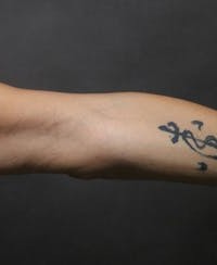 Arm Lift after — Dr. Joshua Korman