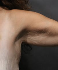 Arm Lift before — Dr. Joshua Korman