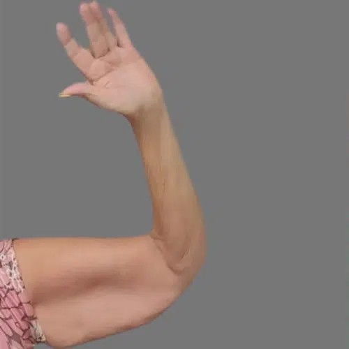 Arm Lift before and after - before