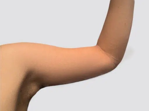 Arm Lift before and after - after