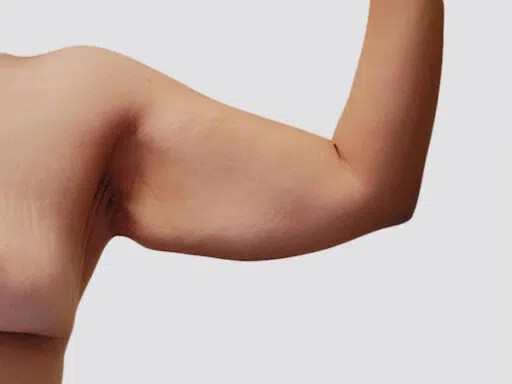 Arm Lift before and after - before