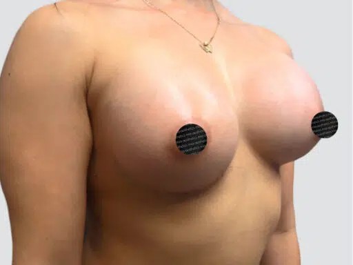 Breast Augmentation before and after - after