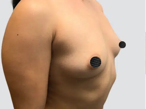 Breast Augmentation before and after - before