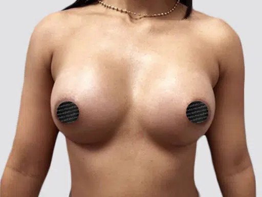 Breast Augmentation before and after - after