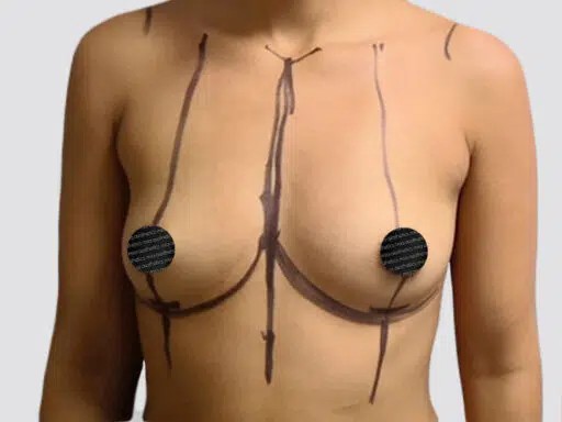 Breast Augmentation before and after - before