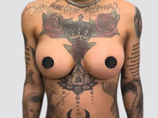 Breast Augmentation before and after - after
