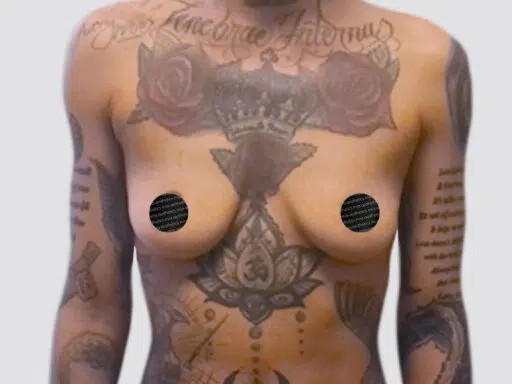 Breast Augmentation before and after - before