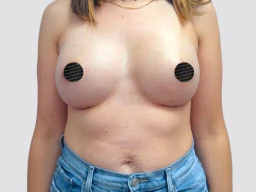 Breast Augmentation before and after - after