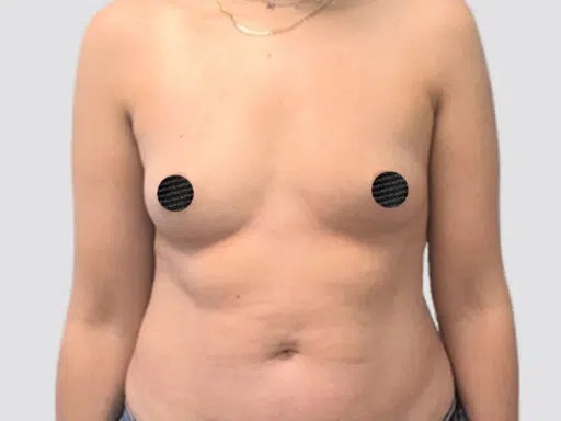 Breast Augmentation before and after - before