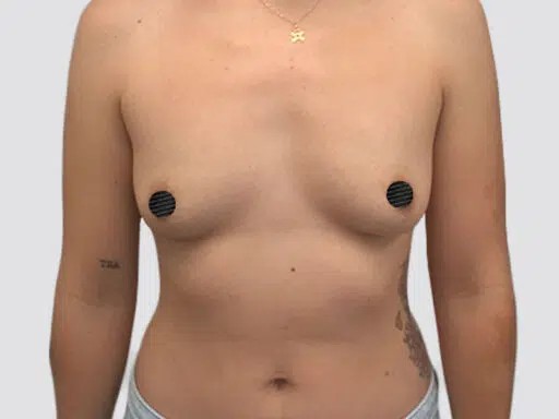 Breast Augmentation before and after - before