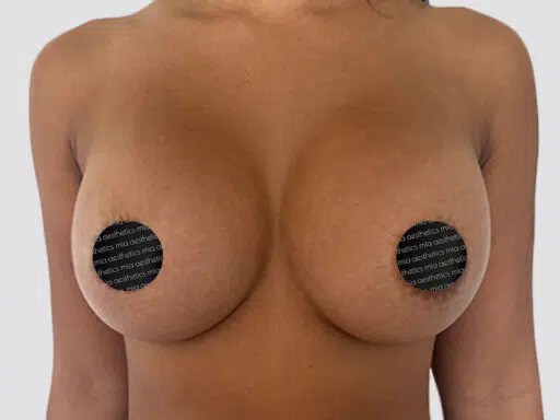 Breast Augmentation before and after - after