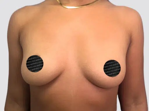 Breast Augmentation before and after - before