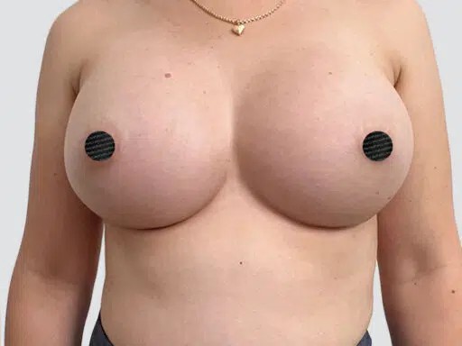 Breast Augmentation before and after - after