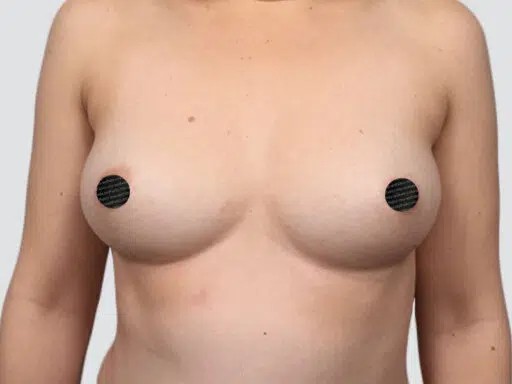 Breast Augmentation before and after - before