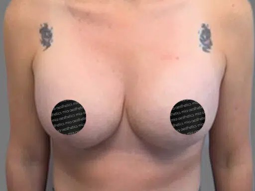 Breast Lift before and after - after
