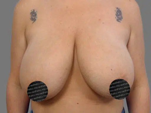 Breast Lift before and after - before