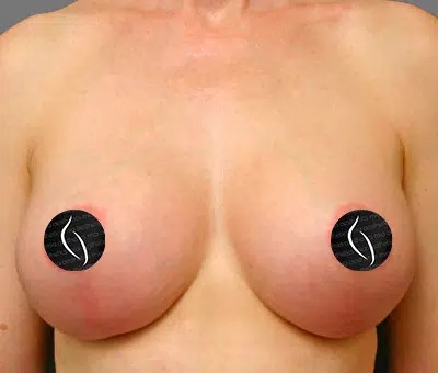Breast Lift before and after - after