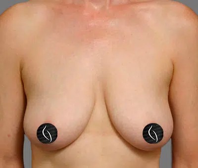 Breast Lift before and after - before