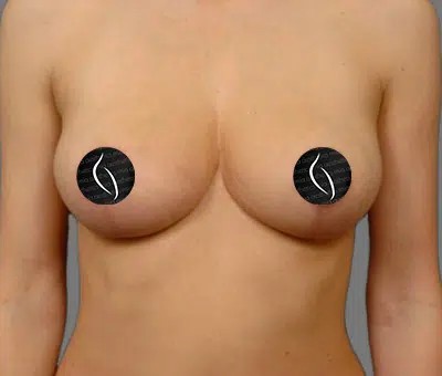 Breast Lift before and after - after