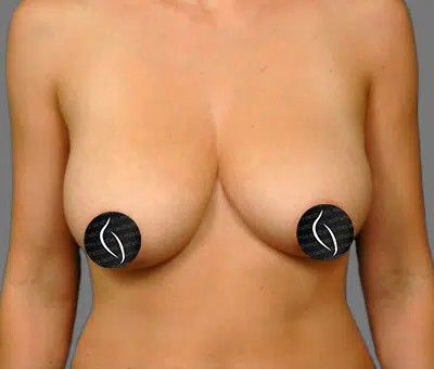 Breast Lift before and after - before