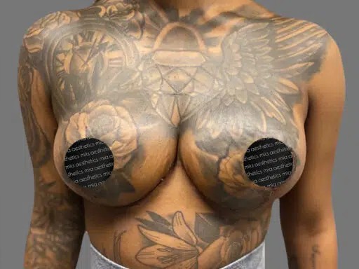 Breast Reduction before and after - after