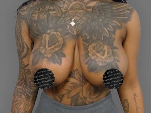 Breast Reduction before and after - before