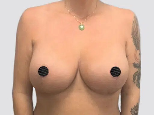 Breast Reduction before and after - after