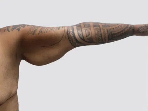 Arm Lift before and after - before