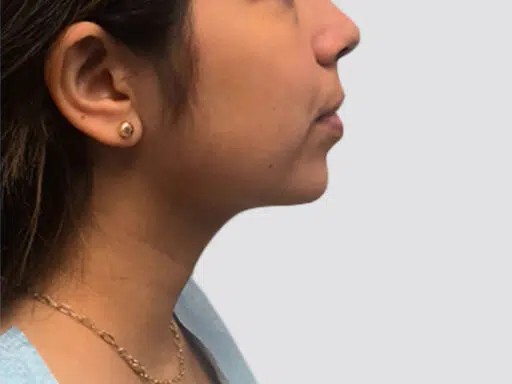 Chin Lipo before and after - after