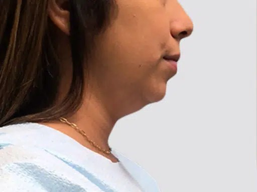 Chin Lipo before and after - before