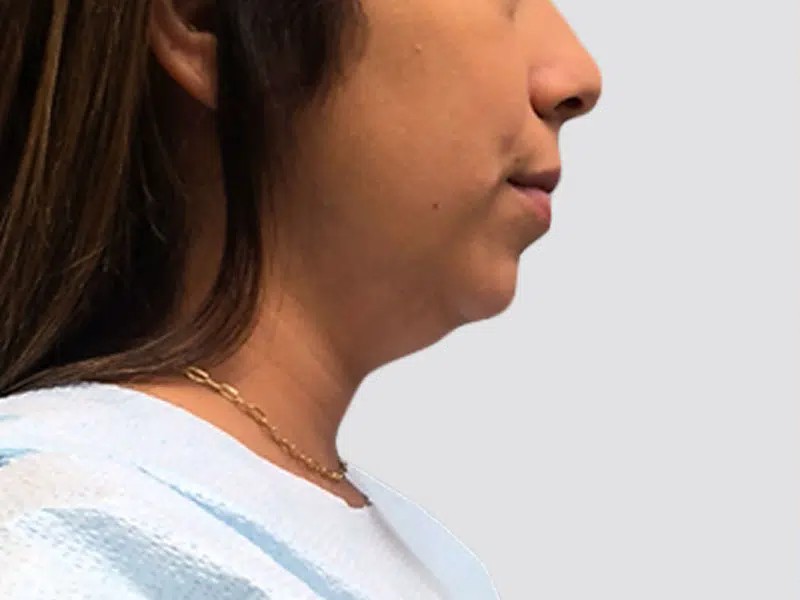 Chin Lipo before and after - before