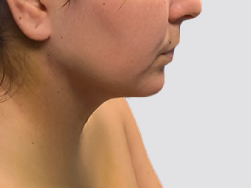 Chin Lipo before and after - after