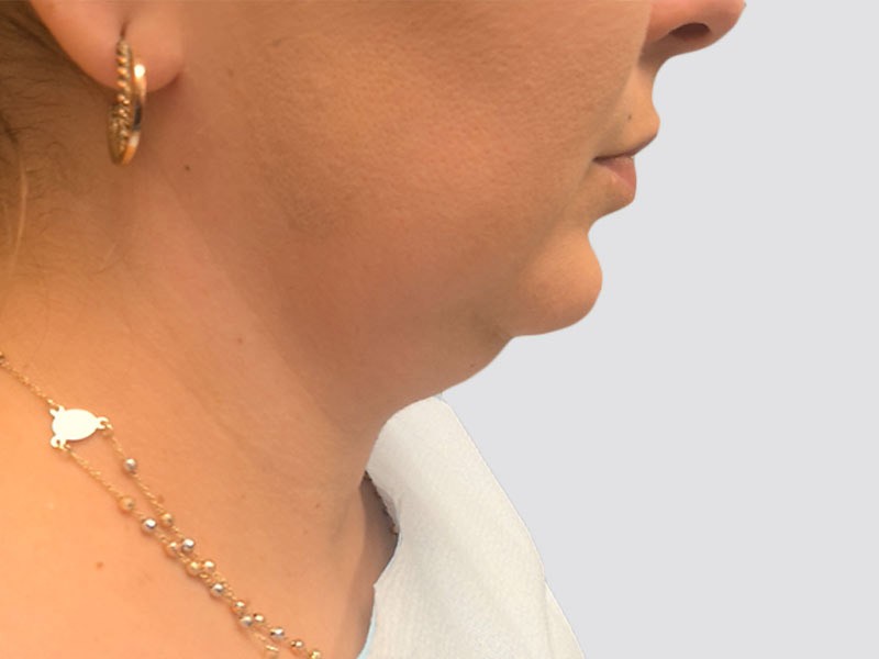 Chin Lipo before and after - before