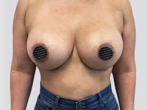 Breast Augmentation before and after - after