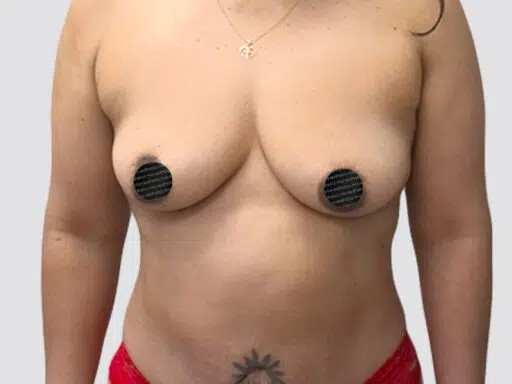 Breast Augmentation before and after - before