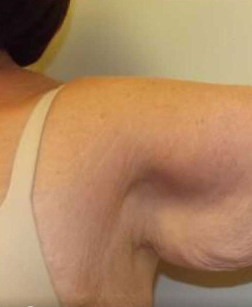 Arm Lift before and after - before