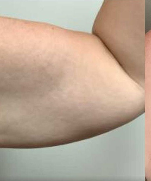Arm Lift before and after - after