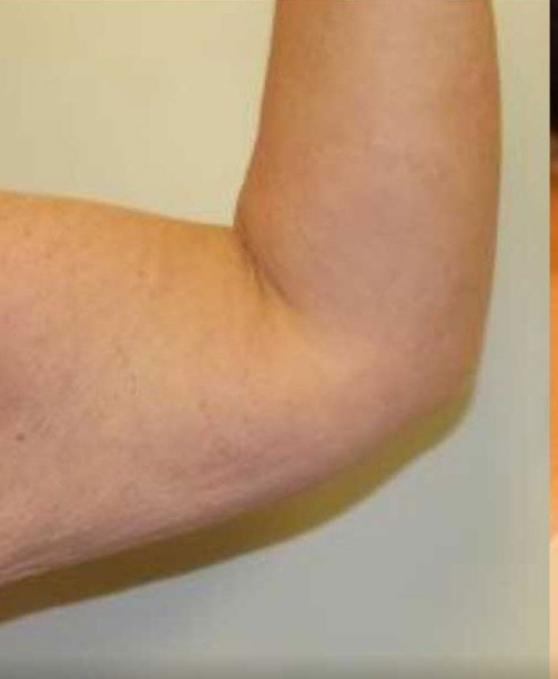 Arm Lift before and after - after